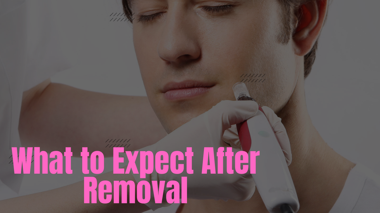 What to Expect After Removal